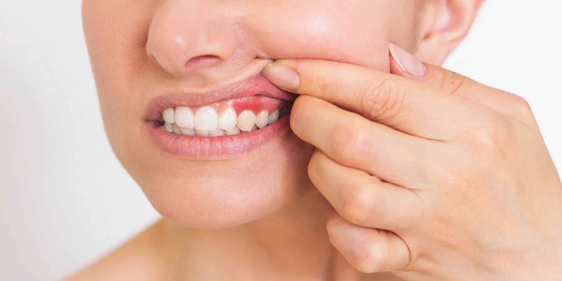 Gingivitis vs. Periodontitis: What’s the Difference?