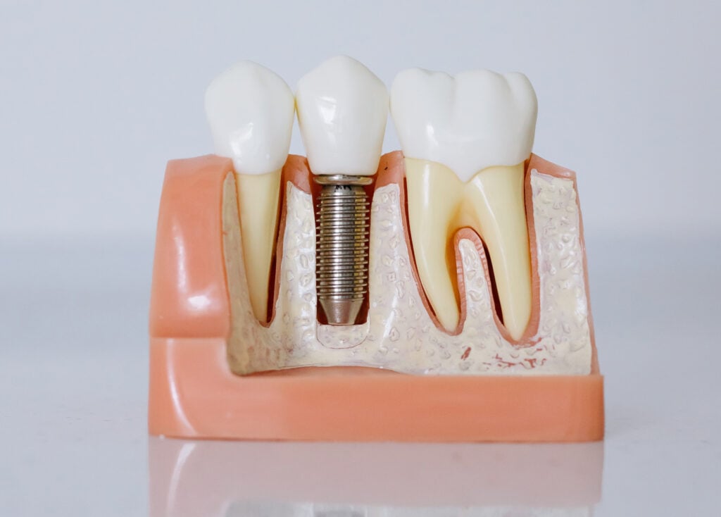Dental Implants San Francisco