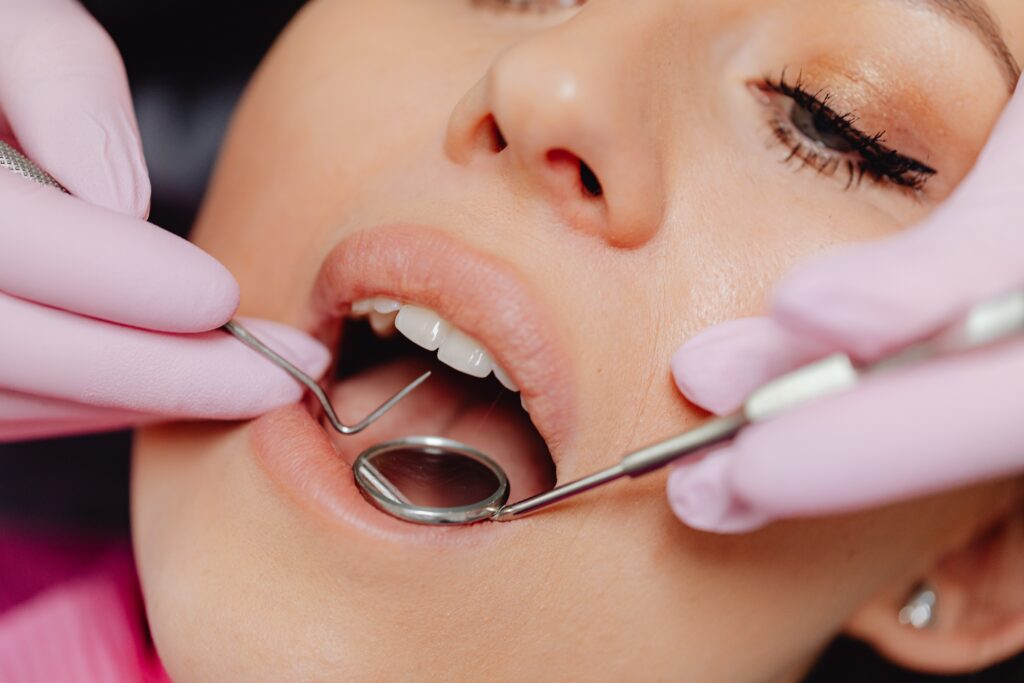 Dental Fillings San Francisco
