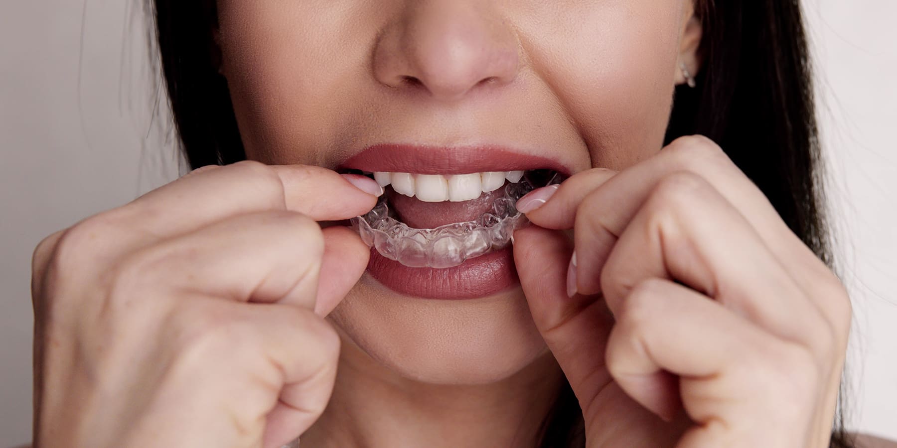 ClearCorrect for the SF Professional: Discreet Solutions for a Confident Smile